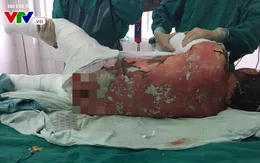 Cảnh báo tổn thương da nghiêm trọng do dị ứng thuốc