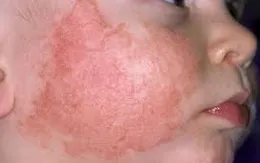 Những bất thường ở da thường gặp ở trẻ