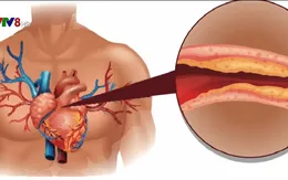 Phát hiện mới: Lượng cholesterol tốt quá cao dễ gây đau tim