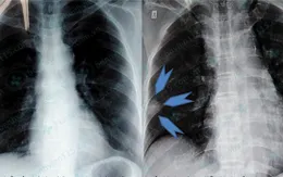 Cứu sống bệnh nhân bị thuyên tắc phổi bằng thuốc tiêu sợi huyết