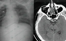 Lái xe mắc tiểu đường suýt chết vì... quên ăn sáng