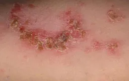 Bệnh chốc ở trẻ em có nguy hiểm?