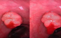 Nội soi cấp cứu người phụ nữ bị polyp trực tràng xuất huyết