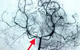 Một bé gái 3 tuổi bị vỡ phình mạch não