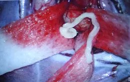 Hãi hùng: Sán nhái 7cm chui lên não gây đau đầu, co giật