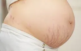 Làm sao để xóa mờ vết rạn da sau sinh?