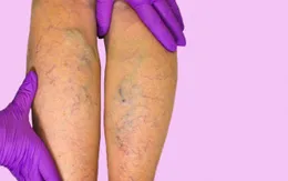 Làm công việc phải ngồi một chỗ, coi chừng bị giãn tĩnh mạch chân