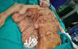 Phẫu thuật giải phóng "cánh đại bàng" bám chặt cơ thể một phụ nữ suốt 40 năm