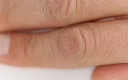 Phòng tránh bệnh viêm da, vẩy nến trong mùa đông