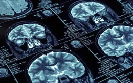 Tuổi thơ nghèo có thể ảnh hưởng đến sự phát triển trí não