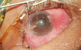 Đi rừng chặt cây mây, người đàn ông bị gai đâm thủng mắt