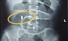 Bi nam châm gây tắc ruột bé gái 6 tuổi ở TP.HCM