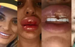 Suýt hoại tử môi vì tiêm filler vào động mạch