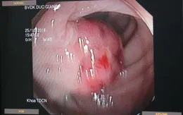 Cắt polyp đại tràng kích thước 2,5 cm