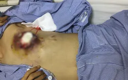 Lở loét, ngực chảy mủ... vì điều trị ung thư bằng thuốc nam
