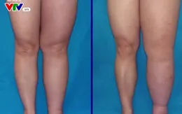 Lần đầu điều trị bệnh chân voi bằng kỹ thuật siêu vi phẫu