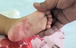 Hơn 3.200 ca mắc, đừng chủ quan với bệnh tay chân miệng