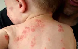 Viêm da cơ địa: Nỗi ám ảnh khôn cùng