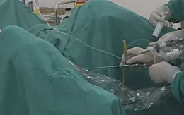 Hy hữu ca thủng ruột non do thói quen ngậm tăm xỉa răng