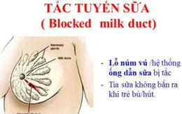 Tắc tia sữa - Nỗi ám ảnh của các bà mẹ sau sinh