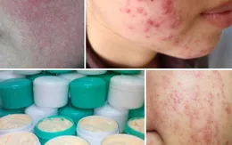 Rước họa vì làm đẹp bằng kem trộn chứa Corticoid
