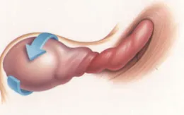 Nam thanh niên nhập viện do xoắn tinh hoàn sau khi chơi thể thao
