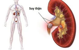 Suy thận mạn tính điều trị thế nào?