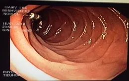Gắp dị vật trâm gai lấy tủy răng trong tá tràng bệnh nhân