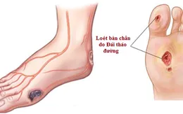 Biến chứng thần kinh ở bệnh nhân đái tháo đường