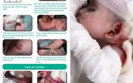 Gian nan hành trình chăm sóc trẻ bị ly thượng bì bóng nước