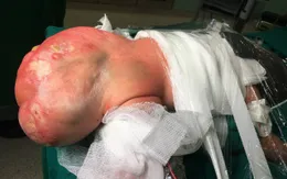 Trẻ sơ sinh mang khối u khổng lồ có da, ruột, chân, tóc