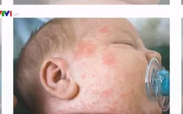 Hơn 85% trẻ mắc sởi nhập viện do chưa được tiêm phòng