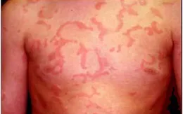 Cách xử trí khi bị mày đay