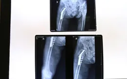 Phẫu thuật gãy mấu chuyển xương đùi phải cho cụ bà 105 tuổi