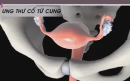 Mỗi ngày, Việt Nam có 7 ca tử vong vì ung thư cổ tử cung