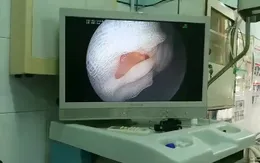 Nội soi thực quản gắp xương heo cho bệnh nhân