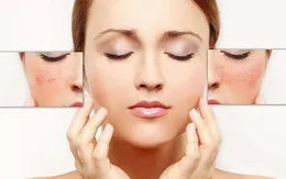 Thận trọng với phương pháp lăn kim làm đẹp da
