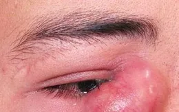 Bắc Giang: Triển khai kỹ thuật nối thông lệ - mũi