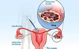 Hội chứng đa nang buồng trứng