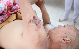 Người đàn ông bị nhiễm trùng nặng do tự tiêm mật gấu vào tay