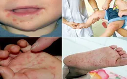 4 bệnh lý dễ khởi phát cần phòng tránh trong mùa hè
