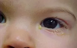 Mắt đổ ghèn nhiều - dấu hiệu không thể coi thường