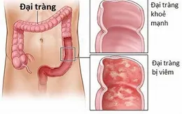 Nếu có các dấu hiệu này, cần đi khám đại tràng ngay