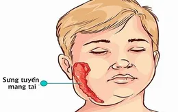 Cảnh báo: Viêm tinh hoàn do quai bị có thể dẫn tới vô sinh