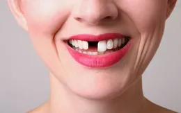 Răng vĩnh viễn mất rồi có mọc lại được không?