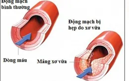 Xơ vữa động mạch chân có nguy hiểm?