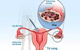 Điều trị hội chứng u đa nang buồng trứng