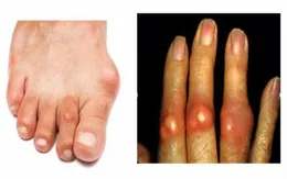 Ăn gì khi bị bệnh gout?