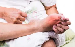 Điều trị bệnh gout theo y học cổ truyền