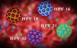 Các giai đoạn phát triển của ung thư cổ tử cung do nhiễm HPV